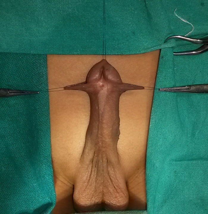 Pediatric Urology Image 3